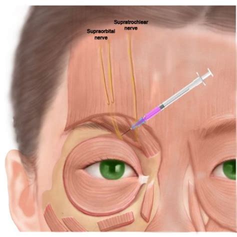 Supraorbital Nerve Block Pain Spa