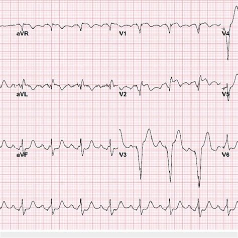 EKG showing atrial-sensed, ventricular paced rhythm after permanent ...