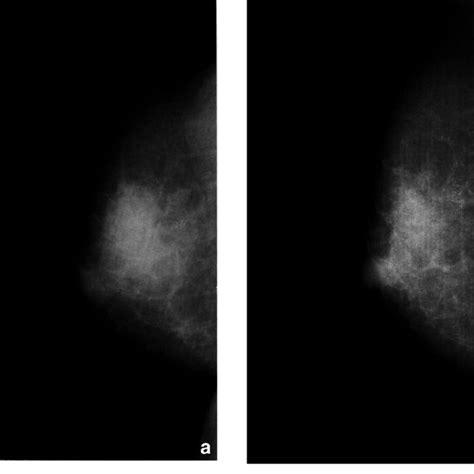 Case 3 A 67 Year Old Postmenopausal Woman Presented With A Right