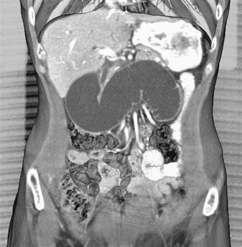 Figure 1 From Acute Afferent Loop Obstruction Treated By Endoscopic Decompression Case Report