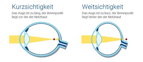 Was Bedeutet Dioptrien Bedeutung Ermittlung Behandlung