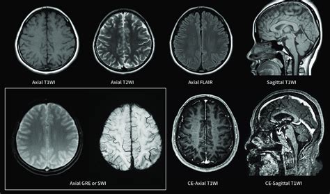 An example of standard imaging technique of brain MRI. Brain MRI ...