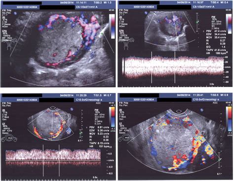 Doppler Velocimetry Showing A Deep Myometrial Invasion With A High