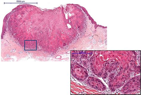 Proliferation Phase Of Keratoacanthoma With Hematoxylin Eosin Staining