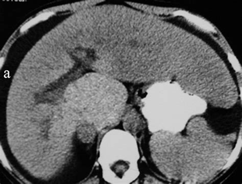 Budd Chiari Syndrome Spectrum Of Imaging Findings AJR