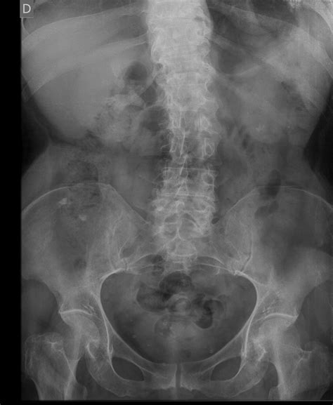 Diagnóstico por Imágenes Litiasis renal coraliforme