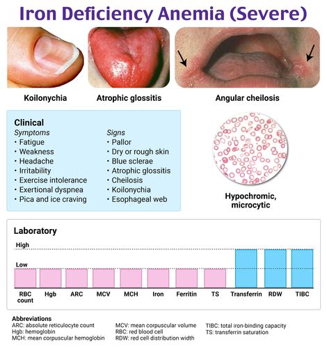 Atrophic Glossitis Iron Deficiency Anemia