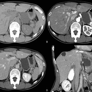 Multiphasic Contrast Enhanced Computed Tomography Findings Unilocular