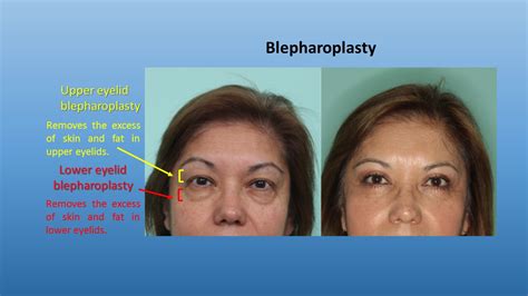 Eyelid Surgery Tijuana Baja California Mx Blepharoplasty