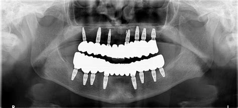 Minimally Invasive Class Ii Restoration Of An Upper Premolar A