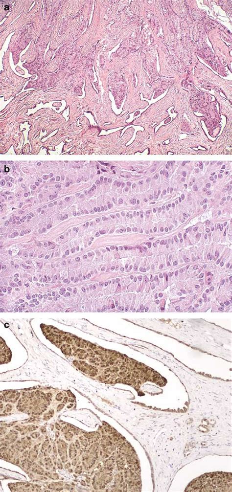 Selected Other Problematic Testicular And Paratesticular Lesions Rete