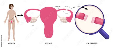 Women Uterus And Cauterized Vector Tubal Ligation Procedures Female