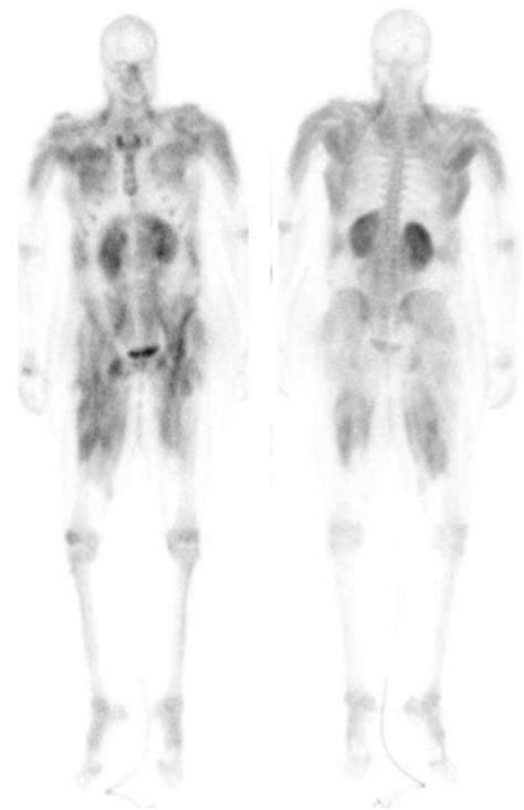 Rabdomiolisis detectada mediante centellograma óseo Historia clínica