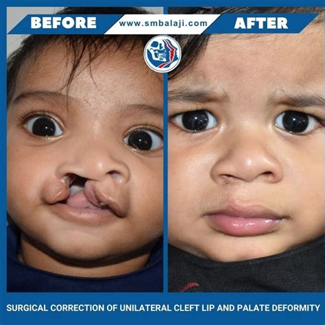 Surgical Mastery In Unilateral Cleft Lip And Palate Correction