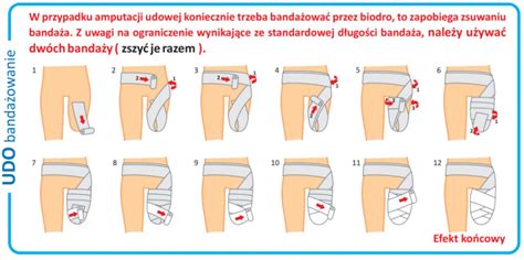 Накладення бандажа на стегно - Протези ніг