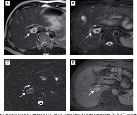 Figure 1 From Use Of Two Dimensional Multiple Slice Magnetic Resonance