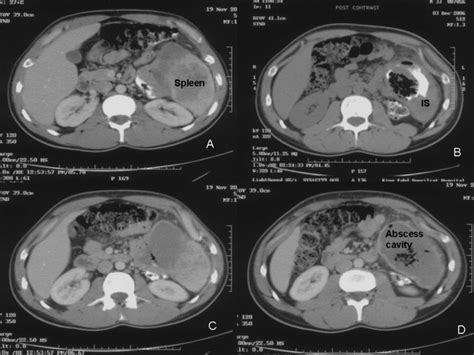 Ct Scan Of The Abdomen Showing What Looked Like Multiloculated Splenic Download Scientific