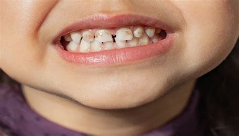 Understanding Dark Spots On Teeth That Aren T Cavities Causes And