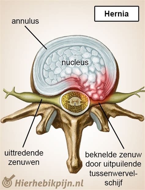 Tussenwervelschijf Anatomie Hier Heb Ik Pijn