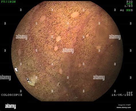 MELANOSIS COLI, ENDOSCOPY Stock Photo - Alamy