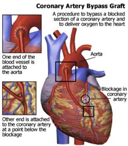 Revascularization Procedures Flashcards Quizlet