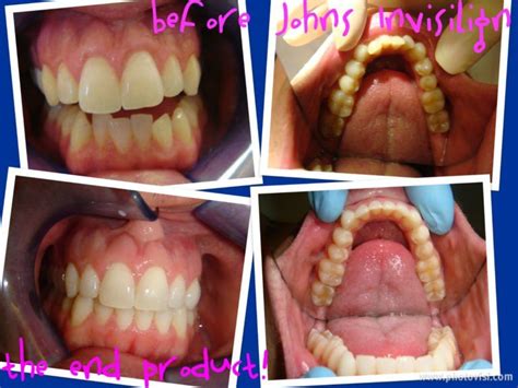 Invisalign Before And After Gallery Advanced Dental Care Quincy Il