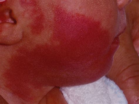 Port Wine Birthmark On Newborn