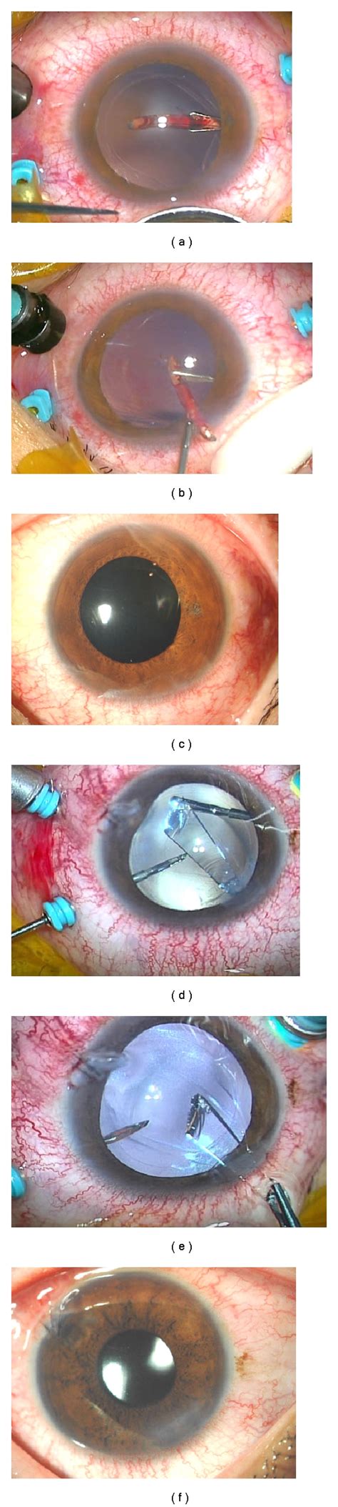 Intraoperative Photographs And Postoperative Slit Lamp Photographs Of