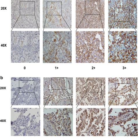 Axl And Gas6 Expression In Nsclc Tumor Tissues A Examples Of Tumoral