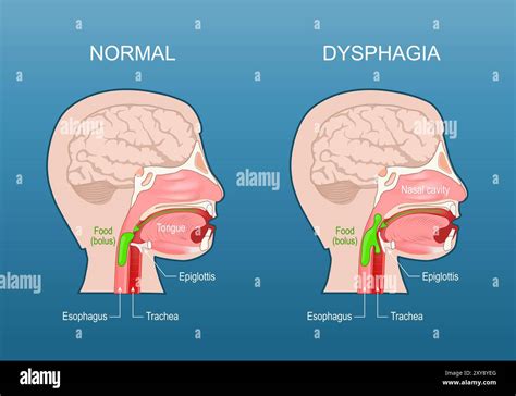 Dysphagia Swallowing Difficulty Esophageal Dysphagia Aspiration Risk