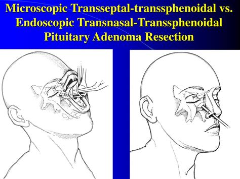 Ppt From An Open Transcranial To A Minimally Invasive Endoscopic