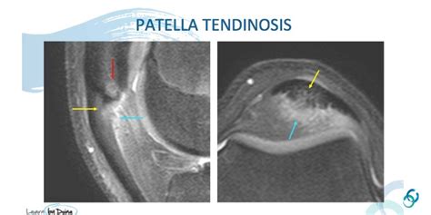 MRI PATELLA: TENDINOSIS AND TEARS - Radedasia