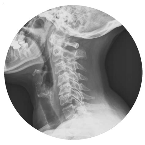 Stages Of Degenerative Disc Disease Neck