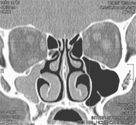 Coronal Computed Tomography Of The Nose And Paranasal S Open I