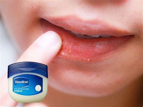 Should I Use Vaseline On My Lips Vinmec