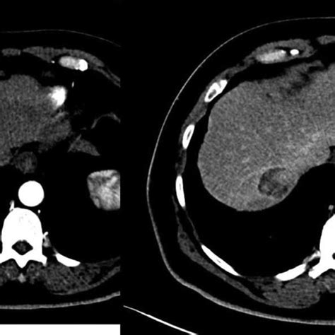 Segment Vii Liver Hcc Abdominal Enhanced Ct Axial Images In The