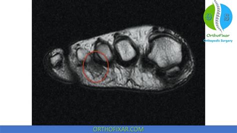 Mortons Neuroma Xray