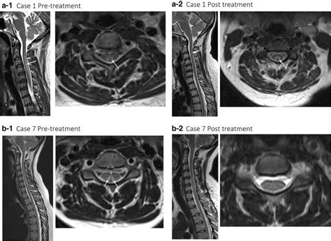 Pre And Post Treatment Sagittal And Axial T2 Weighted Mri Imaging Of