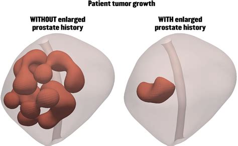 Simulations Of The Prostate [image] Eurekalert Science News Releases