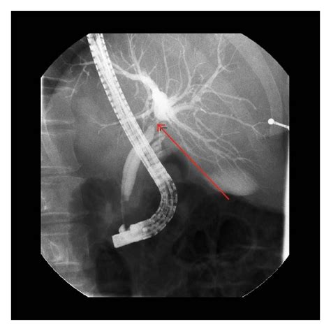 A Magnetic Resonance Cholangiopancreatography MRCP And B