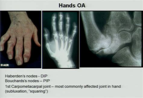 OsteoArthritis Flashcards Quizlet