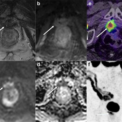 Example Of A Consistent Evaluation Using Mri And Ga Psma Pet Ct