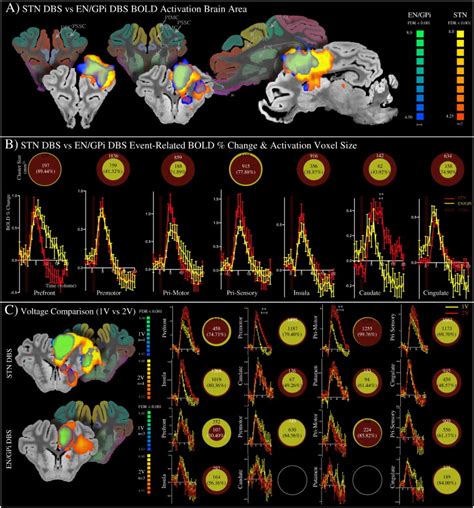 A The Fmri Activation Map Of Stn Red Scale And En Gpi Blue Scale