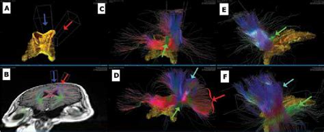 Three Dimensional Visualisation Of Diffusion Tensor Tractography