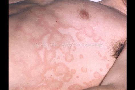 Rheumatic Fever Erythema Marginatum Rheumatic Fever Cardiac Nursing Nursing Pictures