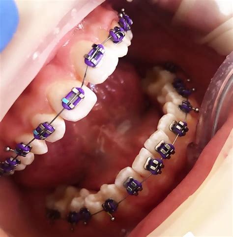 Good Reasons To Choose Purple Braces Braces Explained