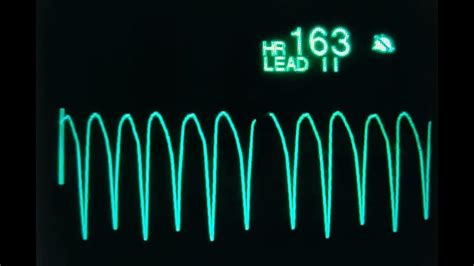 Taquicardia Ventricular Youtube