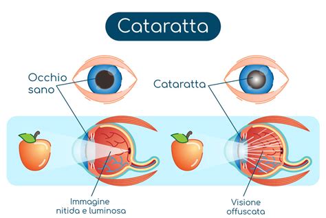 Presbiopia