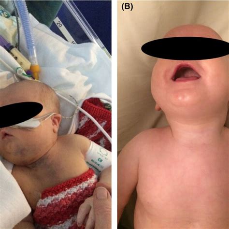 Kaposiform Hemangioendothelioma With KasabachMerritt Phenomenon Before