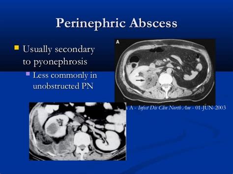 Renal Inflammatory Disease